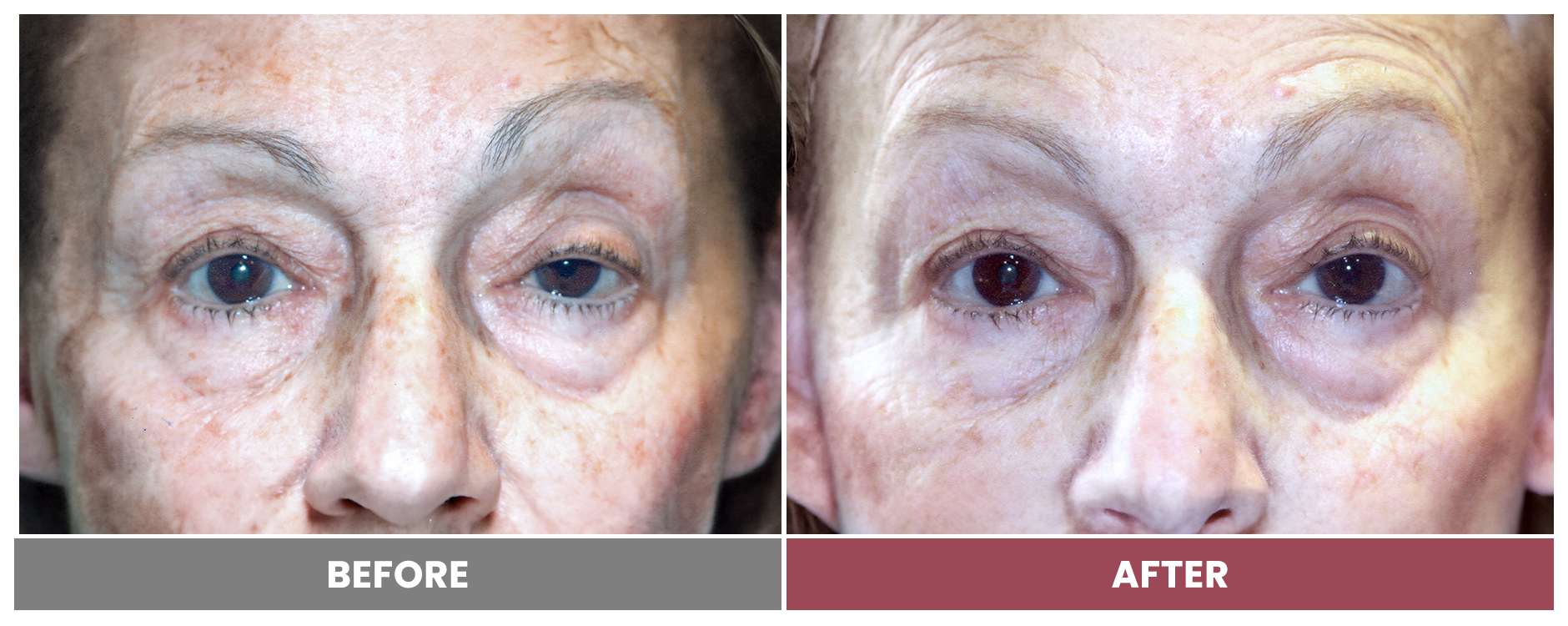 PTOSIS REPAIR - Case 15